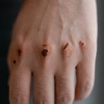 Pourquoi ta cicatrisation prend du retard et comment y remédier ?