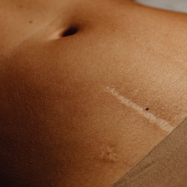 Cicatrice abdominale après opération hernie ombilicale