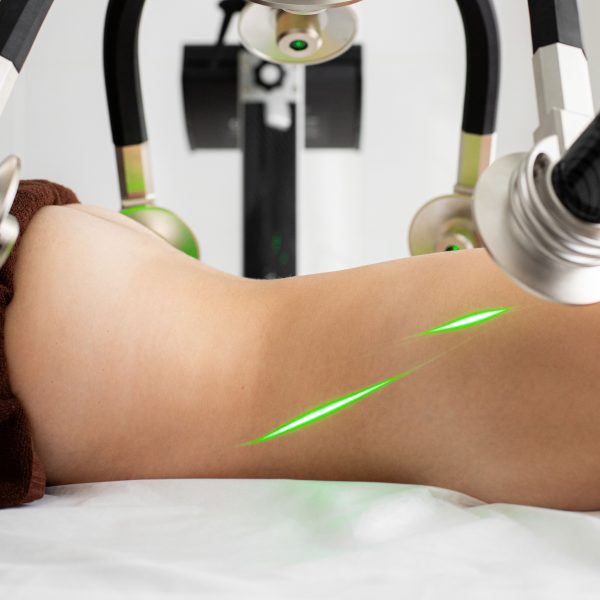 Femme allongée sous machine cryolipolyse moderne